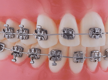 Брекеты Synergy крючок на клыке/премоляре kit SWLF .022 (RMO)